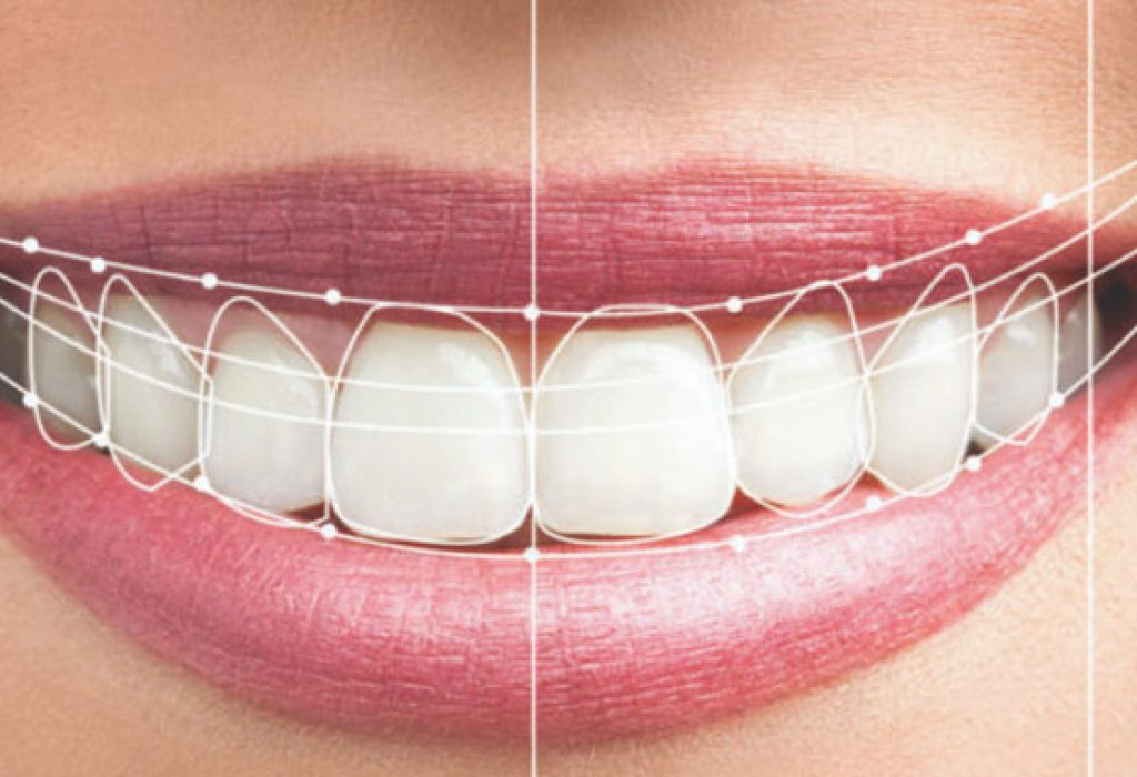 Smile-Design