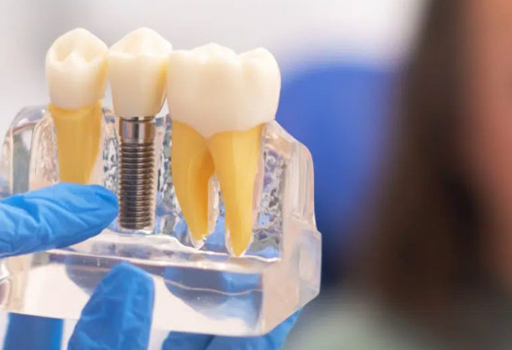 The-Ultimate-Guide-to-Caring-for-Your-Dental-Implants
