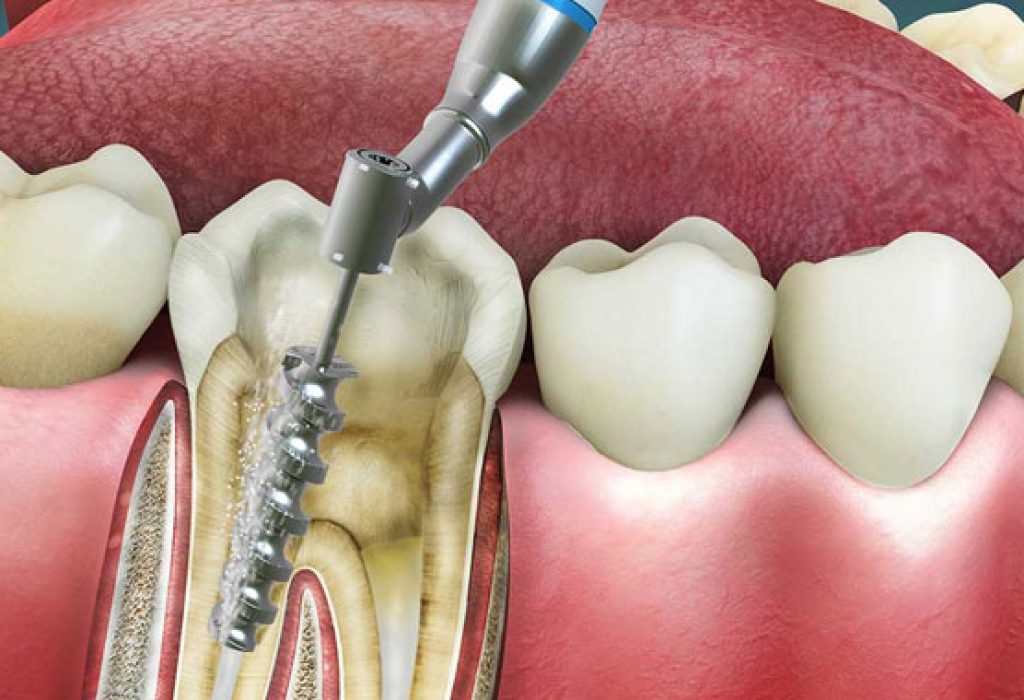 What-Is-Root-Canal-Treatment