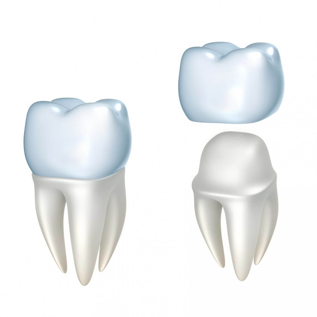 Dental Crowns-and Tooth