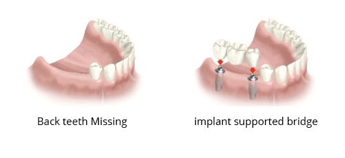 partial missing teeth after repair