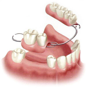 Indications for Dental Implants