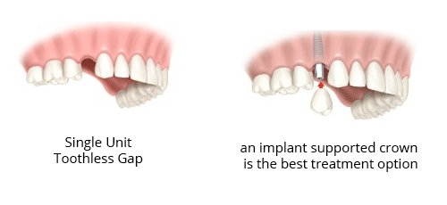 tooth gap before and after repair