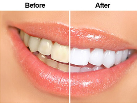 Dental-Scaling-and-Polishing