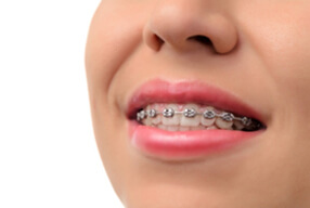 traditional metal braces