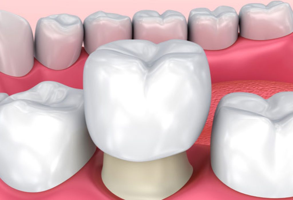 Best-clinic-to-get-Dental-Crowns-in-Ludhiana