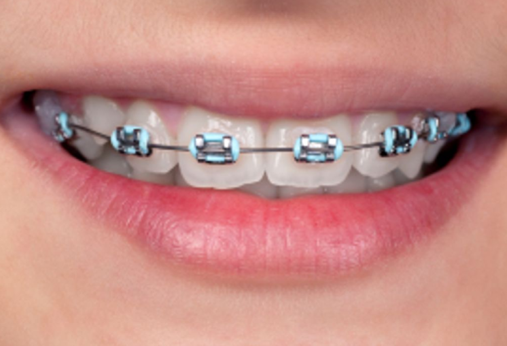 Braces-Necessary