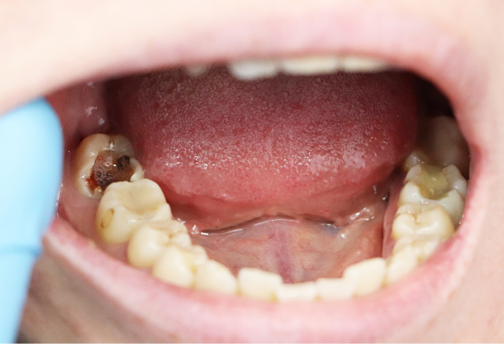 Cavity Prevention in Kids