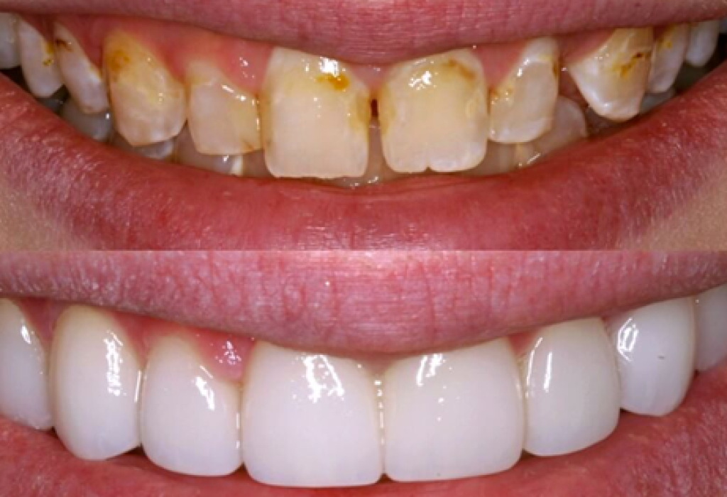 Dental Veneers