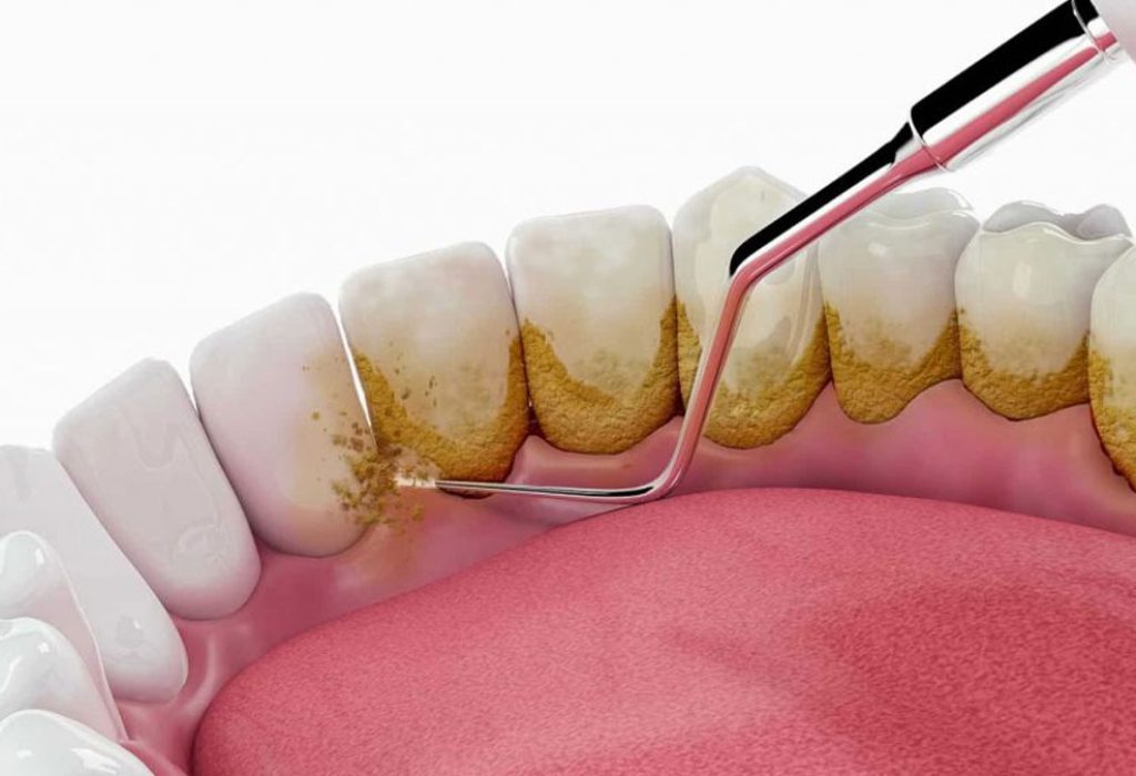 Regular-Scaling-or-cleaning-of-Teeth