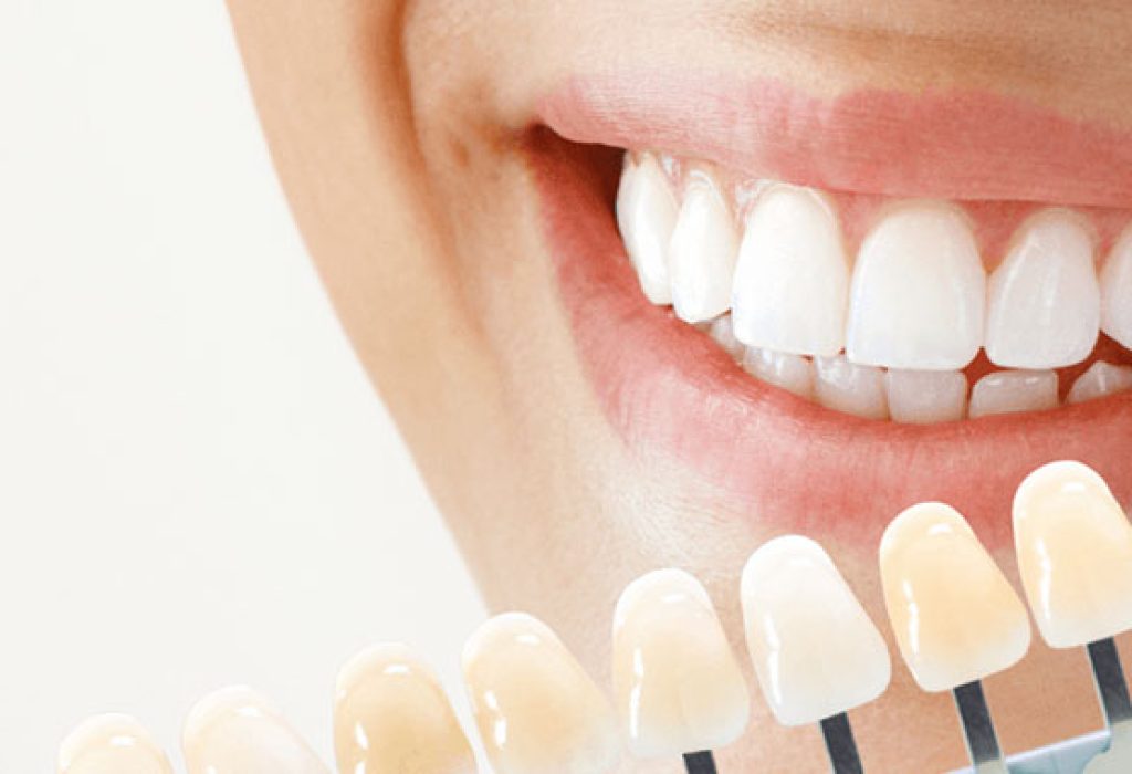 Tooth-Whitening-Brighten-Your-Smile