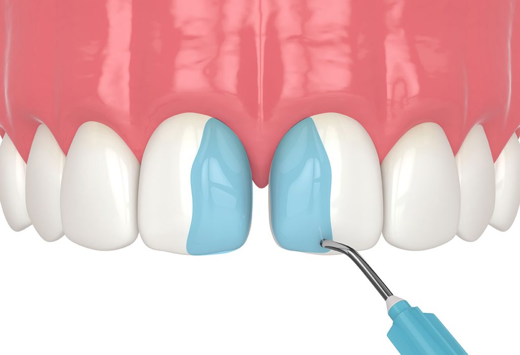 dental-bonding-for-gaps-toms-river-nj